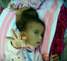 “سوري” يناشد خادم الحرمين بعلاج طفلتيه السياميتين “تقى” و”يقين”